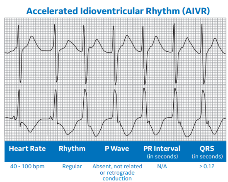 Accelerated Idioventricular Rhythm (AIVR)