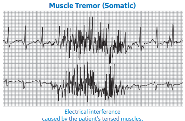 Muscle Tremor (Somatic)
