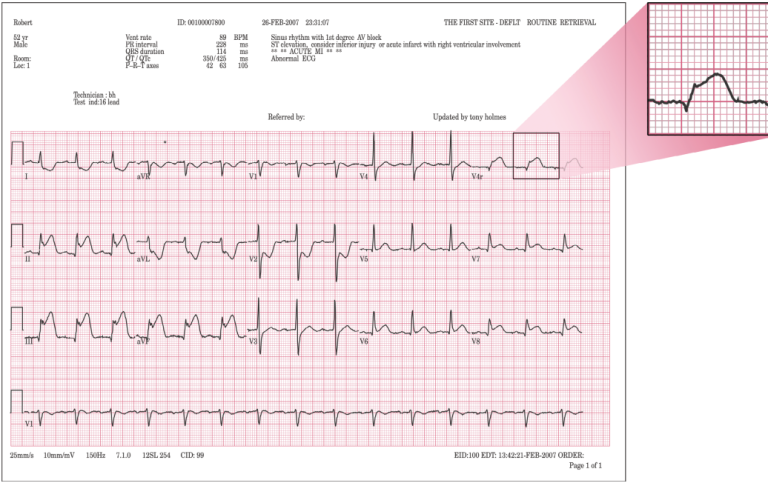 ECG Right Ventricular Involvement