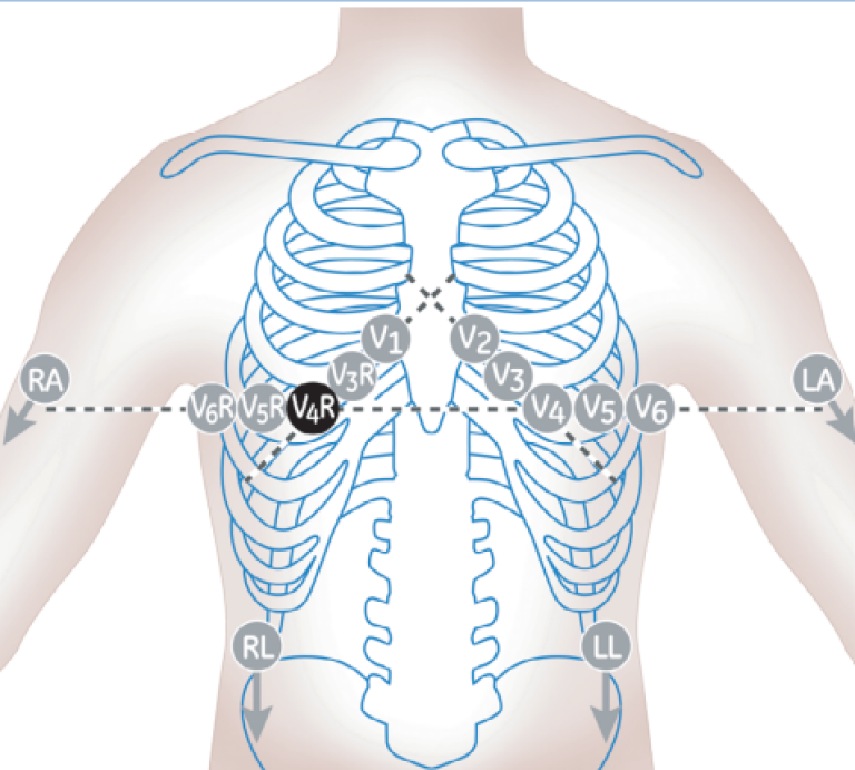 15 lead electrode placement