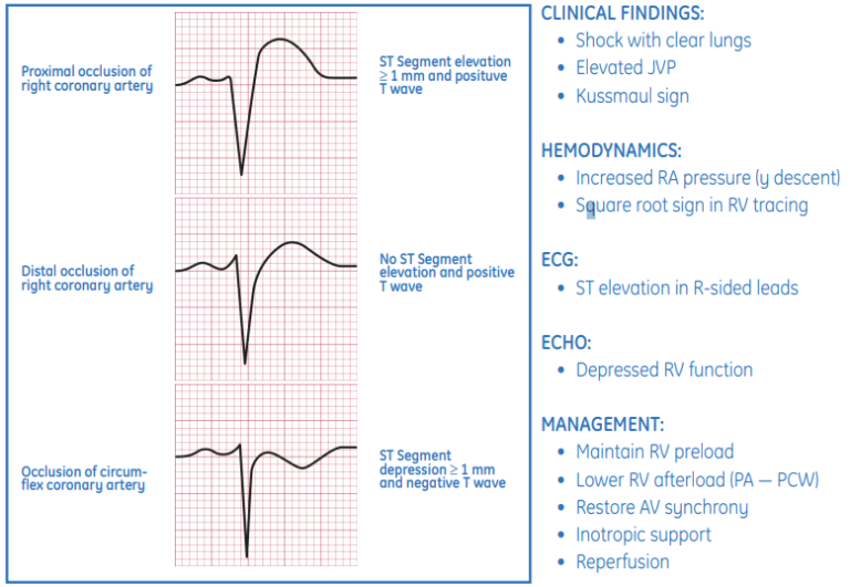 ECG Guidelines for RVI Management