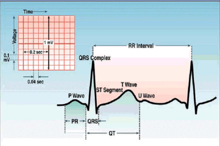 QT and RR Interval Graphs