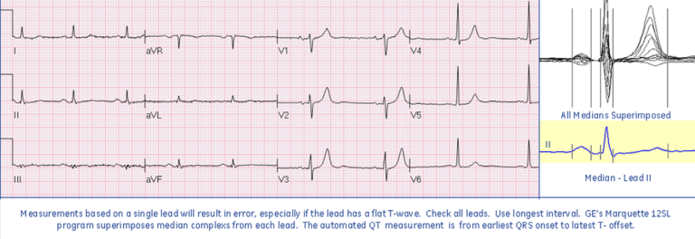 Flat T-wave in Limb Leads