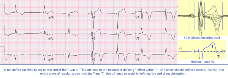 Bi-phasic T-wave