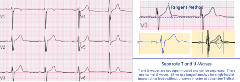 Normal U-waves