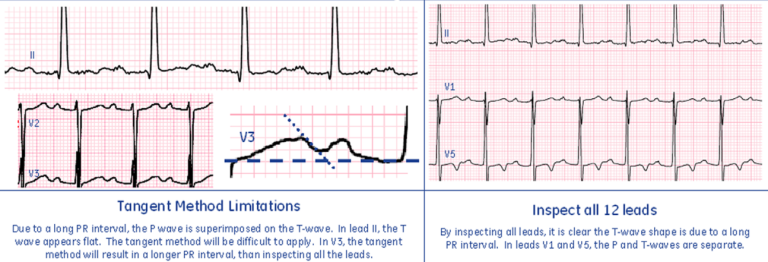TP Fusion - Long PR Interval