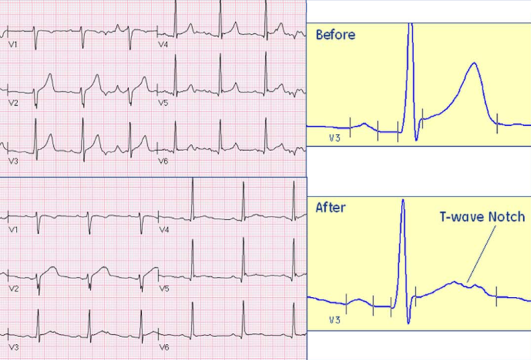T-wave before and after drug effect