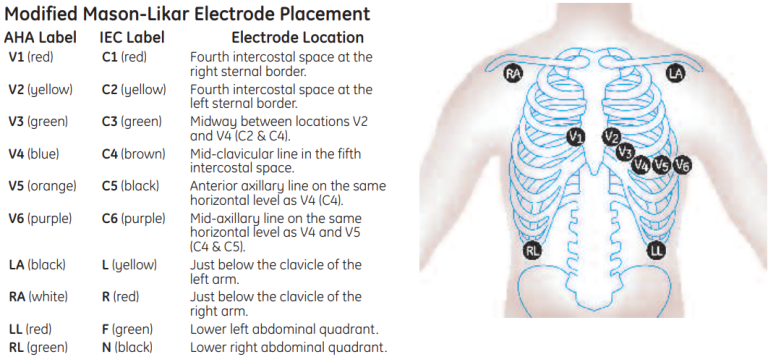 Modified Mason-Likar Electrode Placement