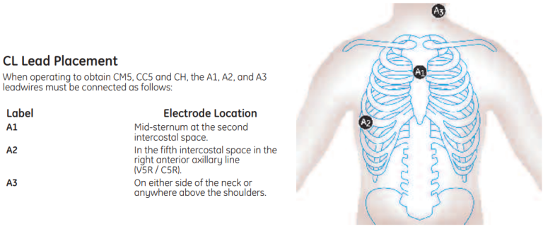 CL Lead Placement