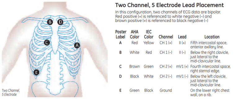 Two Channel, 5 Electrode Lead Placement