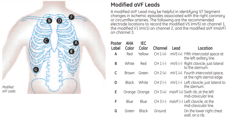 Modified aVF Leads
