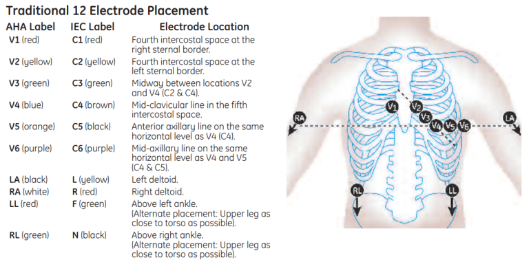 Traditional 12 Electrode Placement