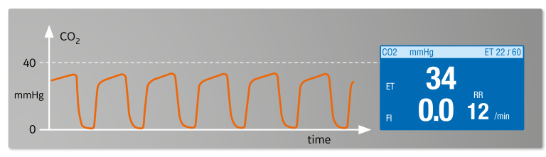 Hypocapnia/Hyperventilation capnogram