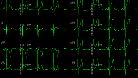 12 ECG waveforms in monitor screen