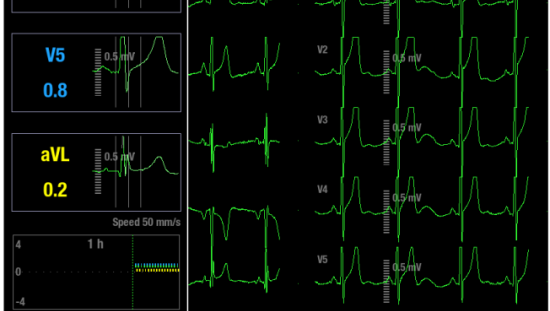 ST-leads and trends