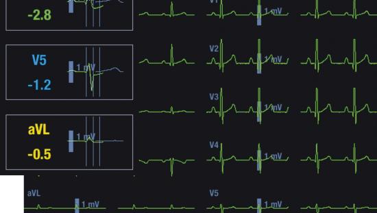 cardiac monitor that contiusly monity st elevation cardiac monitor that contiusly monity st elevation